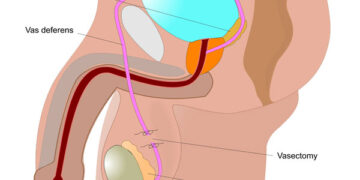 No Scalpel Vasectomy: The Benefits of a Non-Invasive Vasectomy 76