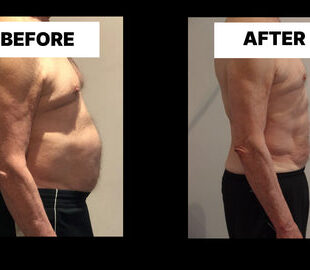 Understanding Diastasis Recti in Men 60