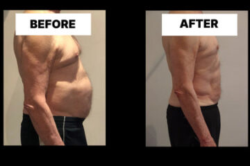 Understanding Diastasis Recti in Men 51