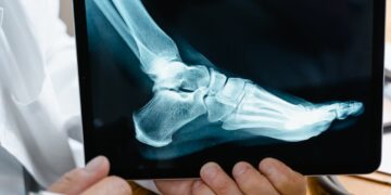 What to Expect from Hammer Toe Surgery 60