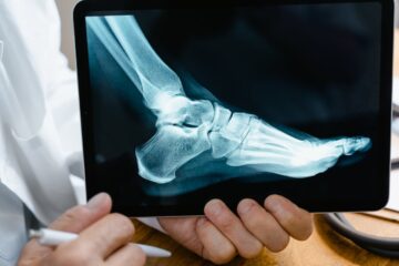 What to Expect from Hammer Toe Surgery 50