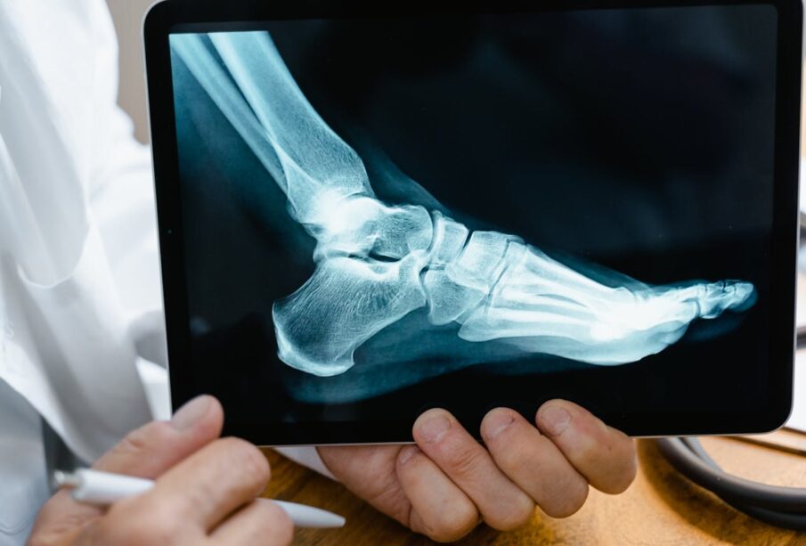 What to Expect from Hammer Toe Surgery 49 What to Expect from Hammer Toe Surgery 49