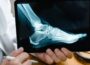 What to Expect from Hammer Toe Surgery 56