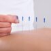 Combining Acupuncture and Physical Therapy in NYC for Faster Healing 1 Combining Acupuncture and Physical Therapy in NYC for Faster Healing