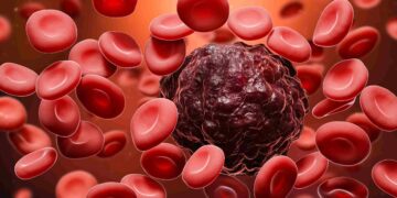 Blood Cancer: A Comprehensive Guide for People Living With This Disease