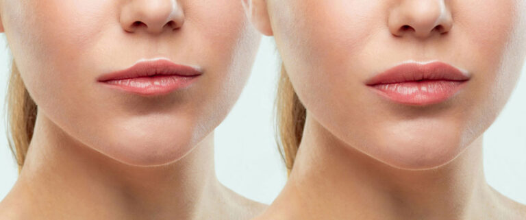 Plump Your Lips with Hyaluron Pen 6