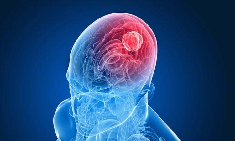 Stage Four Brain Cancer Life Expectancy 9