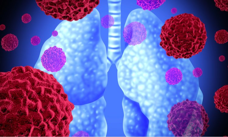 Small Cell Lung Cancer Life Expectancy 6