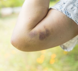 How to treatment bruises at domestic 1 How to treatment bruises at domestic 1