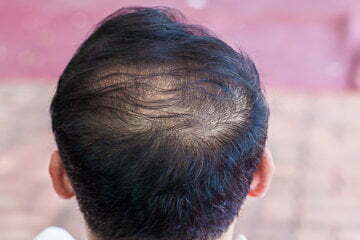 Causes and treatments for thinning hair 3