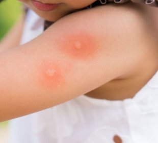 What to understand approximately skeeter syndrome 2