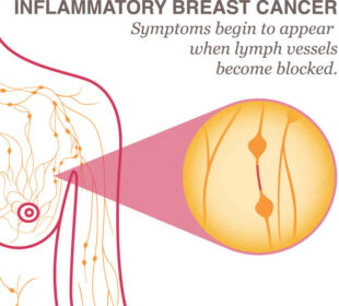 Unusual Breast Cancer Symptoms 15 Unusual Breast Cancer Symptoms 8