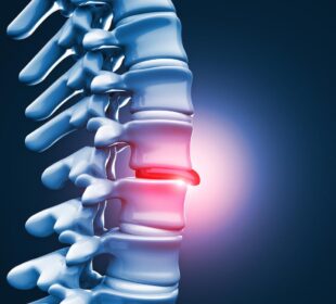 L5 S1 Herniated Disc 8