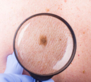 Signs and Symptoms of Skin Cancer  4