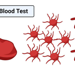 Understanding the MPV Blood Test: What You Need to Know 13 Understanding the MPV Blood Test: What You Need to Know 7