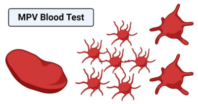 Understanding the MPV Blood Test: What You Need to Know 1 Understanding the MPV Blood Test: What You Need to Know 1