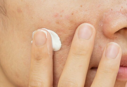 What is a good mole removal cream that actually works? 9