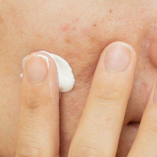 What is a good mole removal cream that actually works? 12